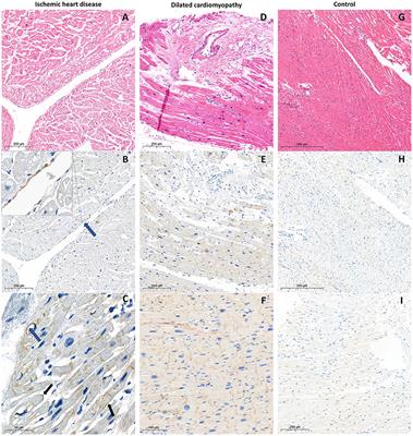 Myocardial PD-L1 Expression in Patients With Ischemic and Non-ischemic Heart Failure